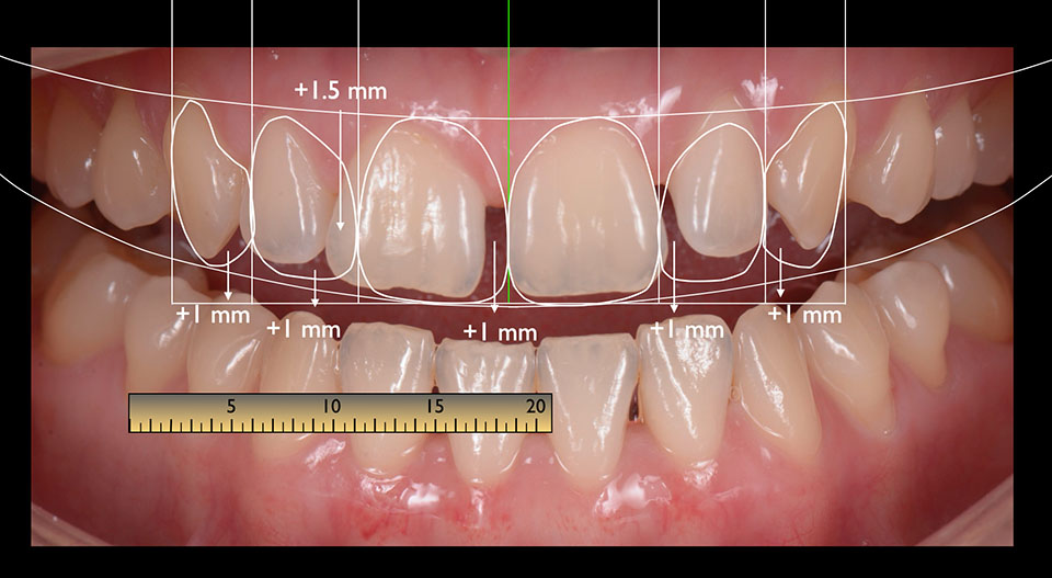Digital Smile Design planavimas