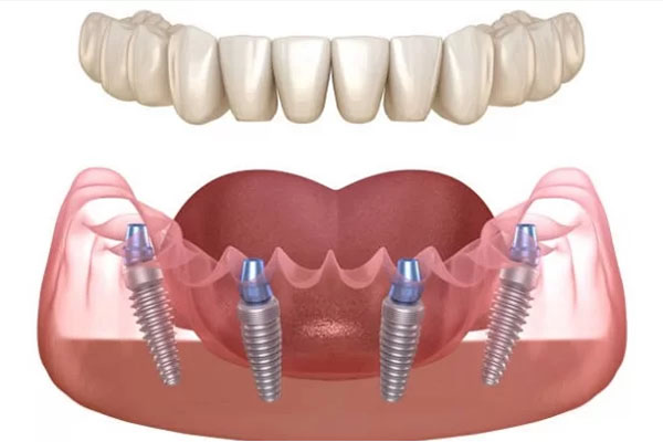 ICX Dantų implantas