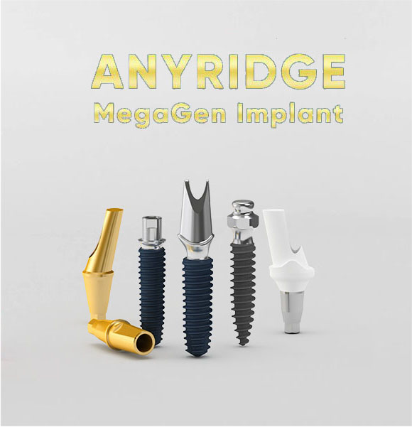 MegaGen Anyridge implantas